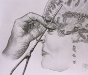 Freeman Lobotomy